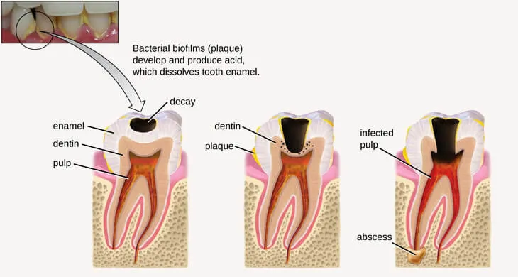 Teeth Diseases