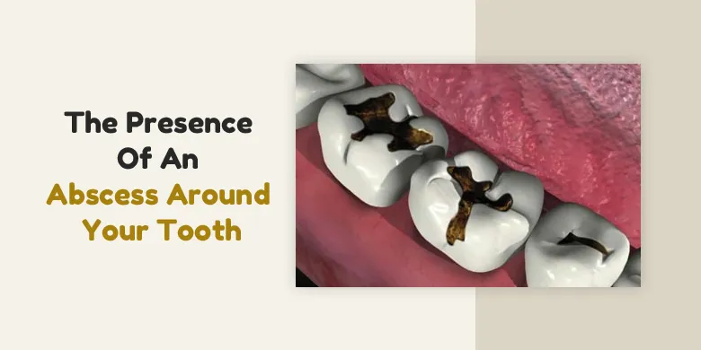 Presence Of Abscess Around Your Tooth