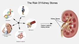 Factors That Increase The Risk Of Kindey Stones
