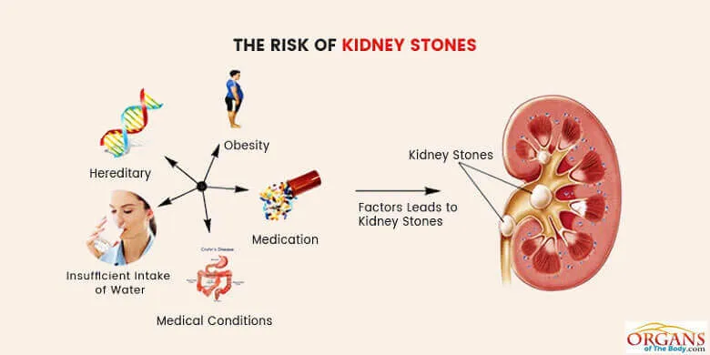The Risk Of Kidney Stones