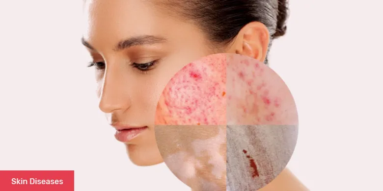 Skin Diseases