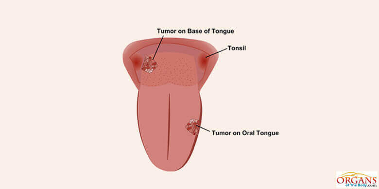 Tongue Cancer