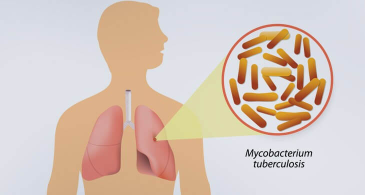 Tuberculosis