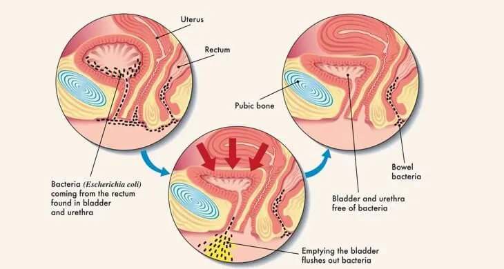 Urinary Bladder Infection